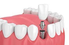 Dental Implants In Newport News, VA
